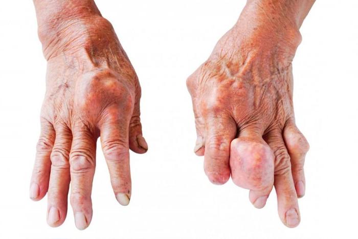 Bệnh gút diễn tiến nặng khiến các khớp sưng đau, biến dạng