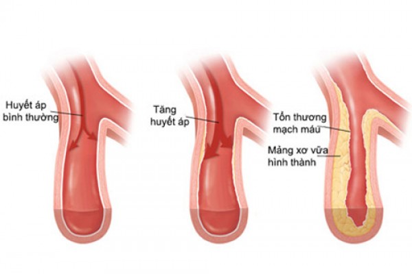 Chất lycopene có trong cà chua giúp ngăn các mảng bám tích tụ trong động mạch