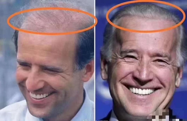 Ông Joe Biden lộ dấu vết cấy tóc, cắt mí, tiêm botox