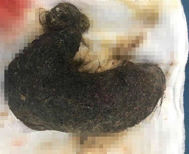 Phẫu thuật lấy khối u khổng lồ dài 20cm trong cơ thể bé gái vì nghiện ăn tóc suốt 9 năm