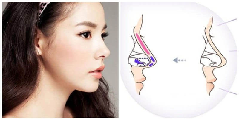 Những phương pháp nâng mũi phổ biến nhất hiện nay, Vụ nâng mũi bị mù mắt: