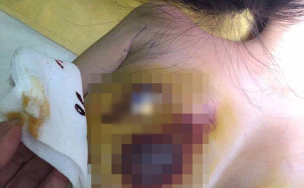 Trước khi phẫu thuật nâng ngực, chị em nhất thiết phải biết những điều này