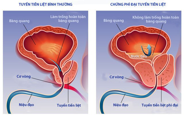 Mất bản lĩnh quý ông sau khi uống 10 thang thuốc nam chữa tiền liệt tuyến