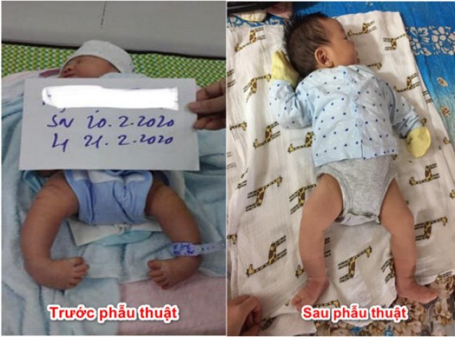 Hình ảnh bệnh nhi tại Nghệ An sau 2 tháng điều trị bệnh chân khoèo bẩm sinh