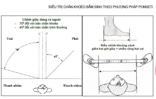 Phác đồ điều trị chân khoèo bẩm sinh theo phương pháo Ponseti