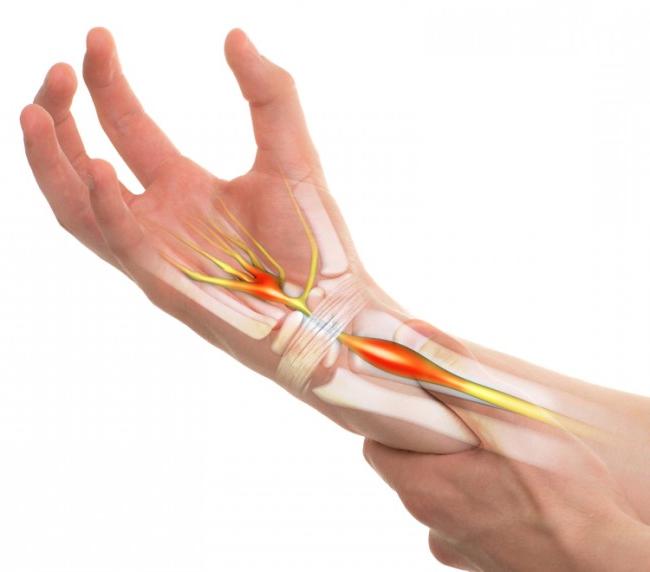Viêm khớp cổ tay xuất hiện triệu chứng rất dễ nhận biết Viêm khớp cổ tay xuất hiện triệu chứng rất dễ nhận biết