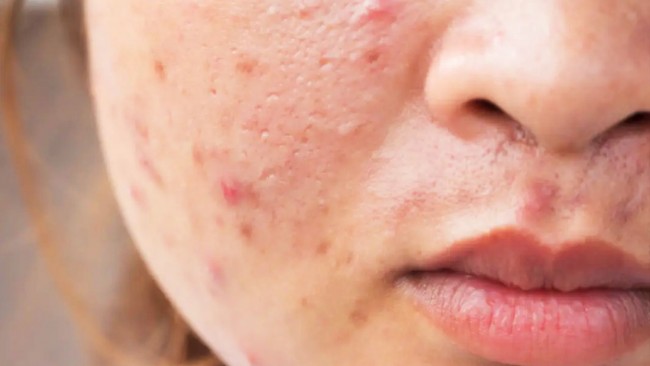 Thông thường da mặt thường xuất hiện nhiều thể mụn cùng lúc