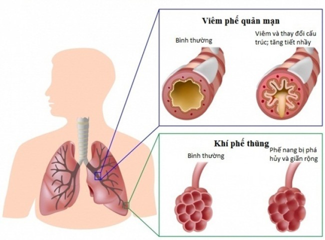 Hình ảnh lâm sàng trong tắc nghẽn bệnh phổi mạn tính