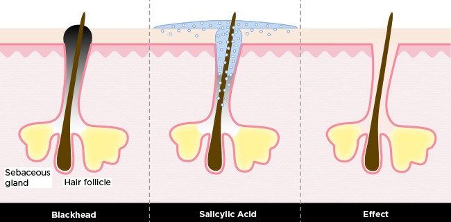 Thành phần Salicylic Acid giúp làm sạch bụi bẩn sâu trong lỗ chân lông