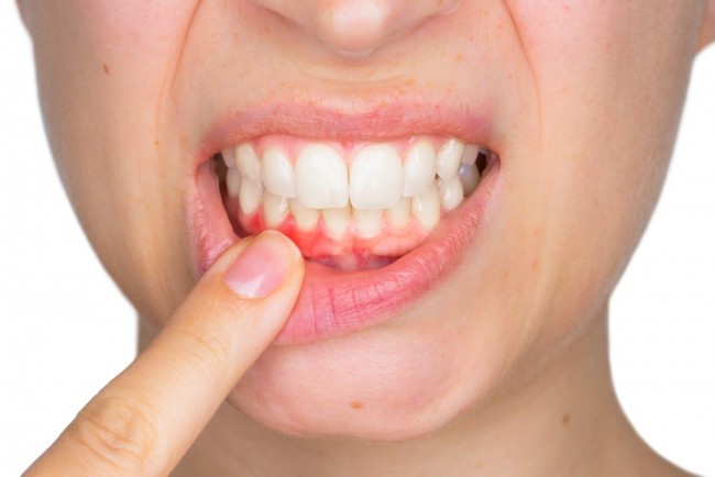 Việc thay đổi nội tiết tố và thói quen sinh hoạt khiến mẹ bầu dễ mắc bệnh răng miệng