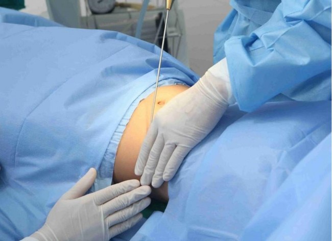 Thao tác dùng Laser Lipo hóa lỏng mỡ thừa