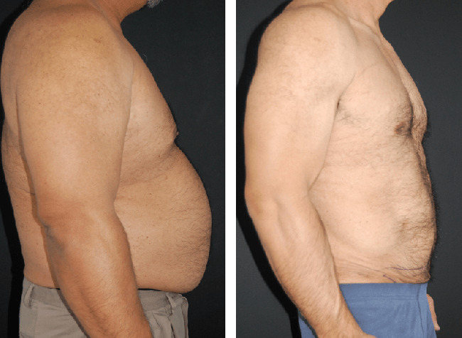 Laser Lipo giảm mỡ hiệu quả, an toàn