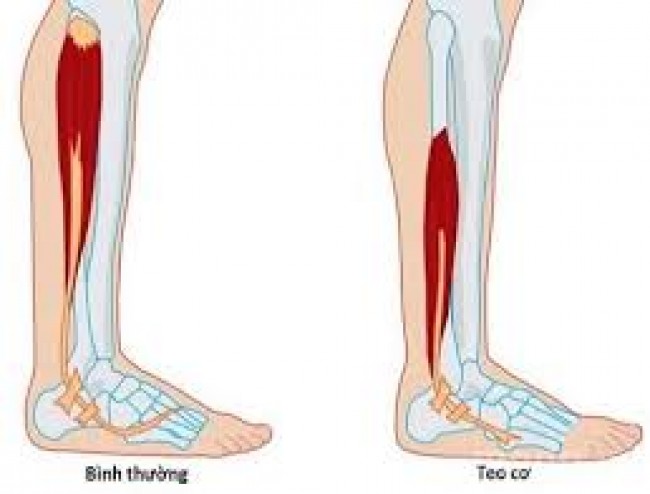 Thoát vị đĩa đệm gây biến chứng teo cơ