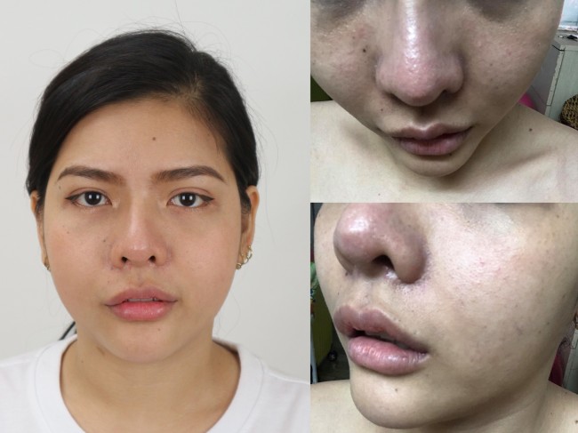 Chiếc mũi hỏng sau nhiều lần thẩm mỹ của chị T.