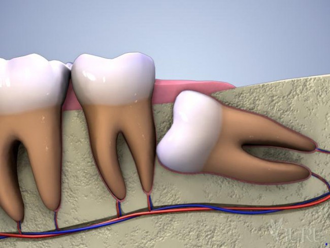 Răng khôn có thể gây ra nhiều biến chứng nguy hiểm