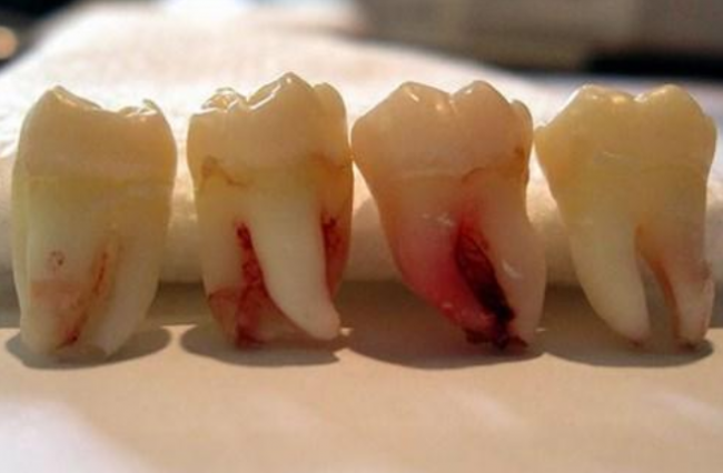 Thông thường con người sẽ có 4 răng khôn