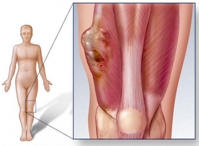 Khối u xương khiến xuất hiện u cục Dấu hiệu bệnh ung thư xương