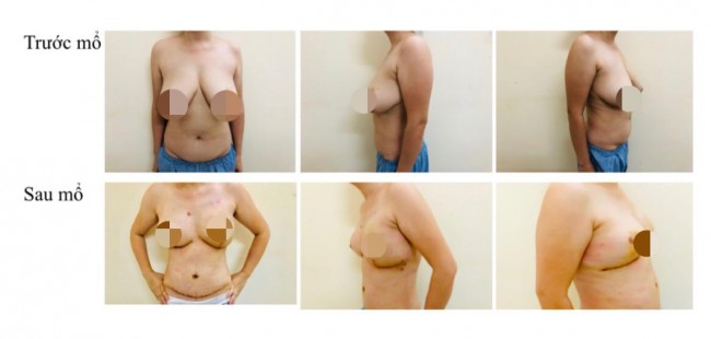 Bệnh nhân trước và sau điều trị, phẫu thuật tái tạo vú