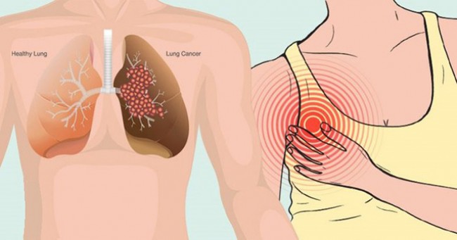 Bệnh nhân ung thư phổi có nhiều bất thường về tâm lý 10 dấu hiệu cảnh báo sớm bệnh ung thư phổi không nên bỏ qua