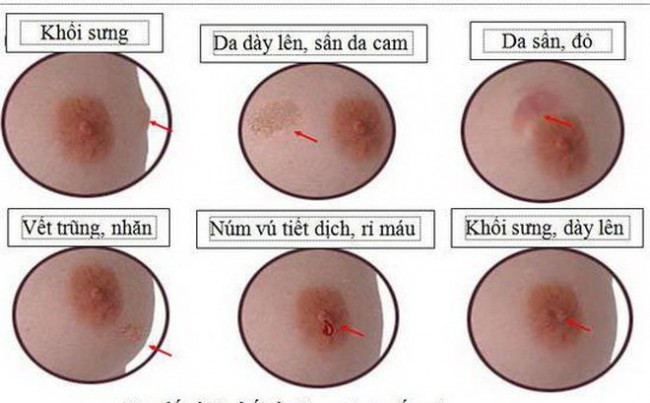 7 dấu hiệu cảnh báo sớm căn bệnh ung thư vú