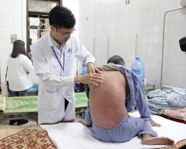 Bệnh vảy nến không lây truyền