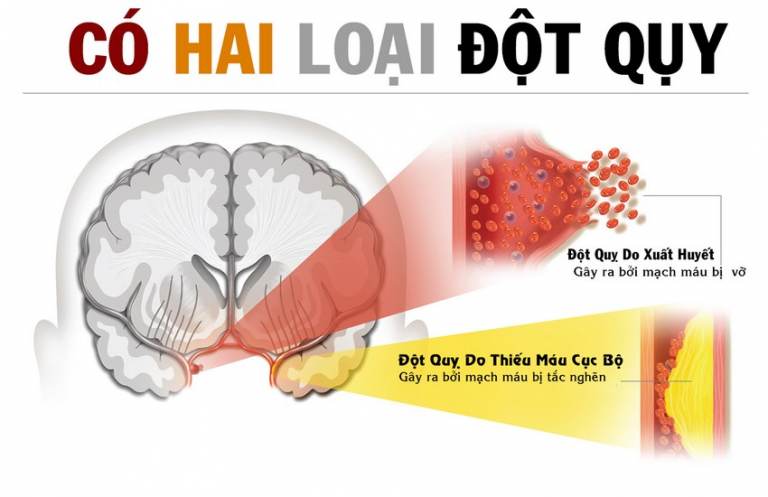 Nhận biết cơn đột quỵ não và tận dụng thời gian 'vàng' để cứu sống bệnh nhân