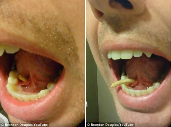 Chàng trai đi khám quai bị, nào ngờ bác sĩ lấy ra viên sỏi từ trong miệng