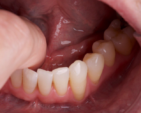 Chàng trai đi khám quai bị, nào ngờ bác sĩ lấy ra viên sỏi từ trong miệng