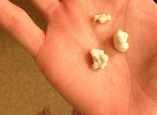 Chàng trai đi khám quai bị, nào ngờ bác sĩ lấy ra viên sỏi từ trong miệng