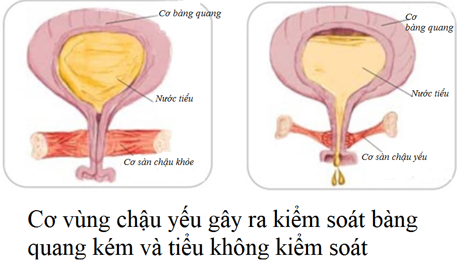 Són tiểu sau sinh do đâu và mẹo hay khắc phục hiệu quả cho chị em Són tiểu sau sinh do đâu và mẹo hay khắc phục hiệu quả cho chị em