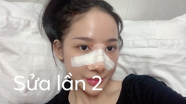 4 lần nâng mũi đến hết sạch sụn tai, cô gái 23 tuổi từng nhiều lần nghĩ quẩn vì phẫu thuật hỏng