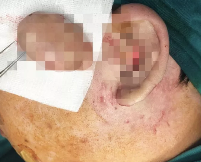 Đôi tai nam thanh niên 'nở hoa' chỉ vì ham hố xỏ khuyên tai cho 'ngầu'
