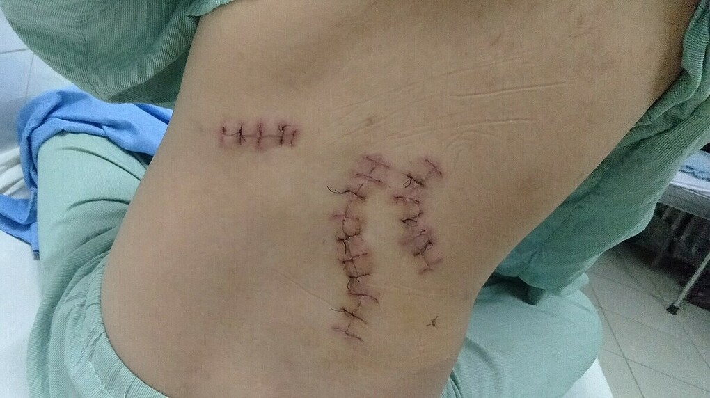 Tài xế xe ôm công nghệ 5 nhát tới mức hỏng thận phải