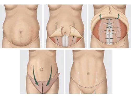 Phẫu thuật thu nhỏ bụng “siêu khủng” cho người phụ nữ 90kg: Nên chọn cách hút mỡ an toàn