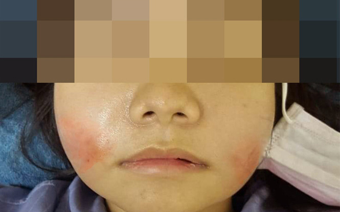 Tiêm filler mặt trẻ hóa ở 1 spa tư nhân, cô gái nhập viện cầu cứu vì hai má nóng đỏ, sưng đau