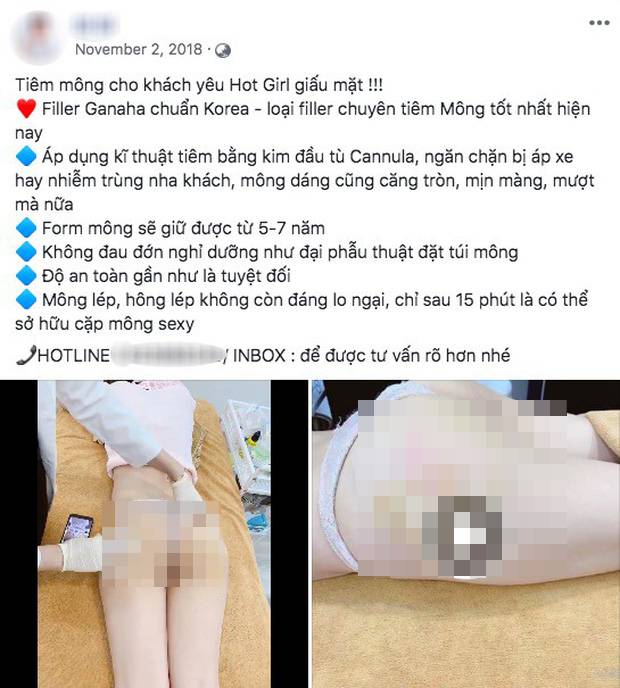 Tiêm mỡ nhân tạo nâng mông gây biến chứng nguy hiểm thế nào? Tiêm mỡ nhân tạo nâng mông gây biến chứng nguy hiểm thế nào?