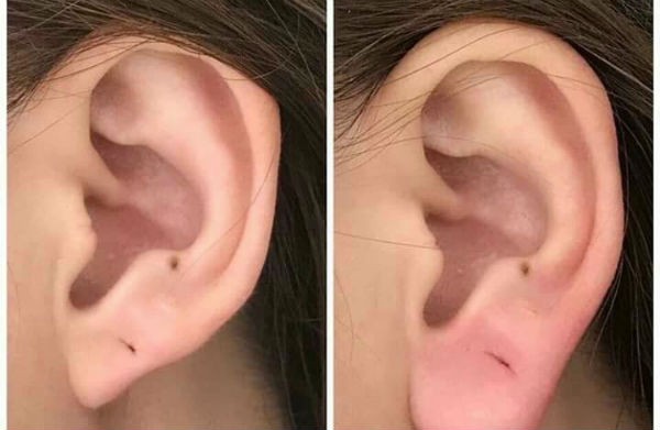 Phương pháp thẩm mỹ “tiêm tai” đang khiến hội chị em điên đảo thật sự có thể “hút tài hút lộc”?