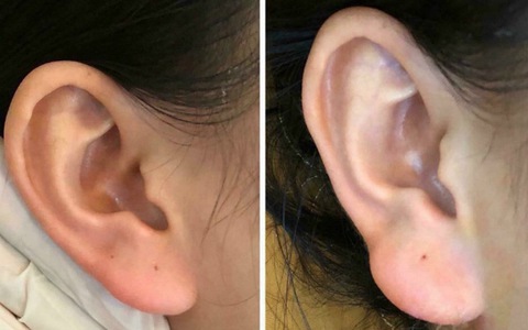 Phương pháp thẩm mỹ “tiêm tai” đang khiến hội chị em điên đảo thật sự có thể “hút tài hút lộc”? Phương pháp thẩm mỹ “tiêm tai” đang khiến hội chị em điên đảo thật sự có thể “hút tài hút lộc”?
