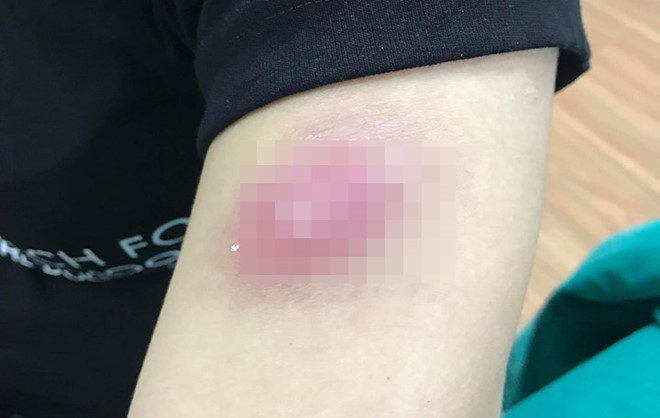 Nhập viện cấp cứu vì tiêm tan mỡ: Hiểm họa khôn lường sau những mũi tiêm giảm cân