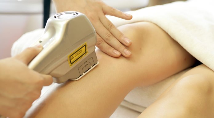 Triệt lông bằng ánh sáng