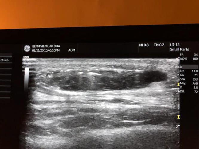 Người đàn ông ở Hà Nội phải nhập viện cấp cứu vì phẫu thuật độn thái dương