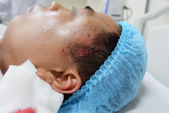 Người đàn ông ở Hà Nội phải nhập viện cấp cứu vì phẫu thuật độn thái dương