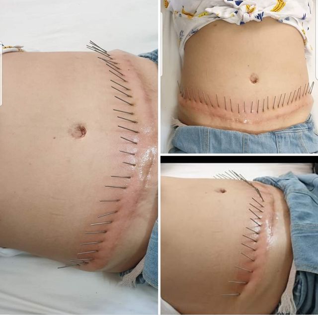 Chi vài triệu để trị sẹo 