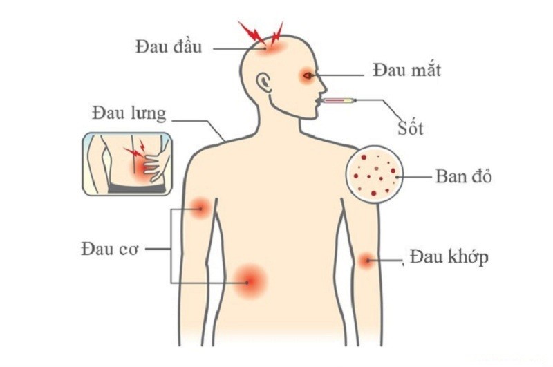 phan-biet-trieu-chung-sot-xuat-huyet-voi-benh-sot-khac2-1728384776.jpg