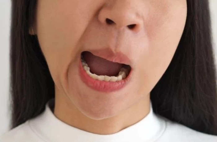 Méo miệng của là một trong những triệu chứng trước khi xảy ra đột quỵ. Ảnh minh hoạ
