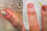 Vệt đen trên móng tay - dấu hiệu bệnh ung thư da bạn không ngờ tới
