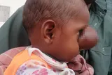 Xót xa cậu bé 8 tháng tuổi có khối u to bằng quả bóng tennis trên mặt 