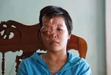 Xót xa cô gái Hà Tĩnh phải nghỉ học từ năm lên 9 vì khối u quái ác trên mặt