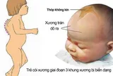 Trẻ còi xương: Dấu hiệu nhận biết và những sai lầm khi chữa trị