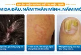 Top 3 nơi trị nấm da uy tín TPHCM: Nấm da đầu, nấm thân mình, nấm móng